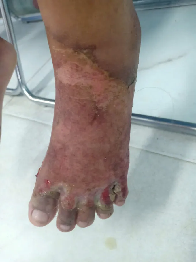 Cháu K. bị bỏng da cẳng bàn chân với tỷ lệ 11% 850f7d219e9038ce6181.jpg