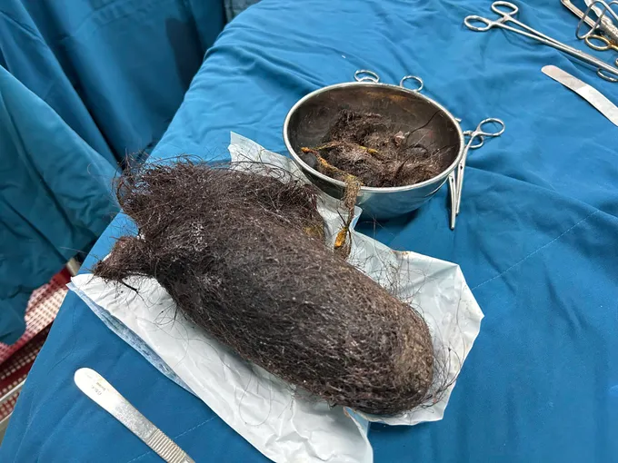 Quảng Ngãi: Phẫu thuật lấy búi tóc nặng 900gram trong dạ dày bé gái