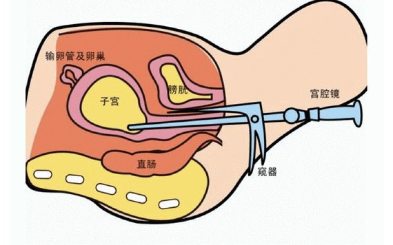 做宮腔鏡有這３種麻醉方式！