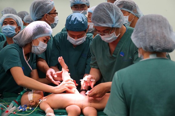 Conjoined twin girls successfully separated in HCMC ảnh 15