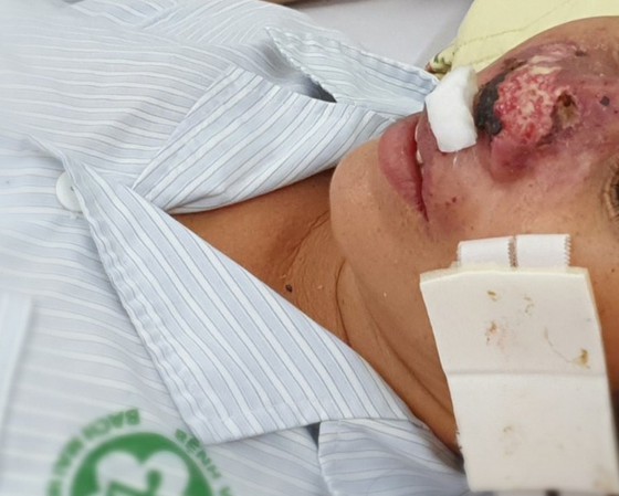 Four people die of rare Whitmore’s disease in North Vietnam