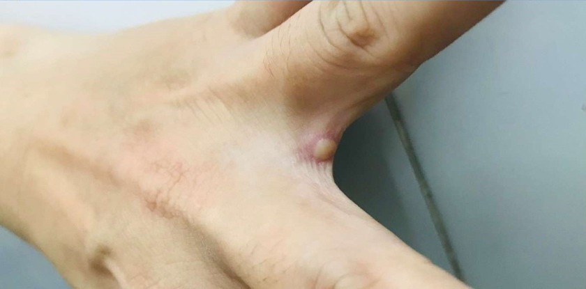 Vietnam’s first monkeypox patient completely cured ảnh 1 Vietnam’s first monkeypox patient completely cured ảnh 1